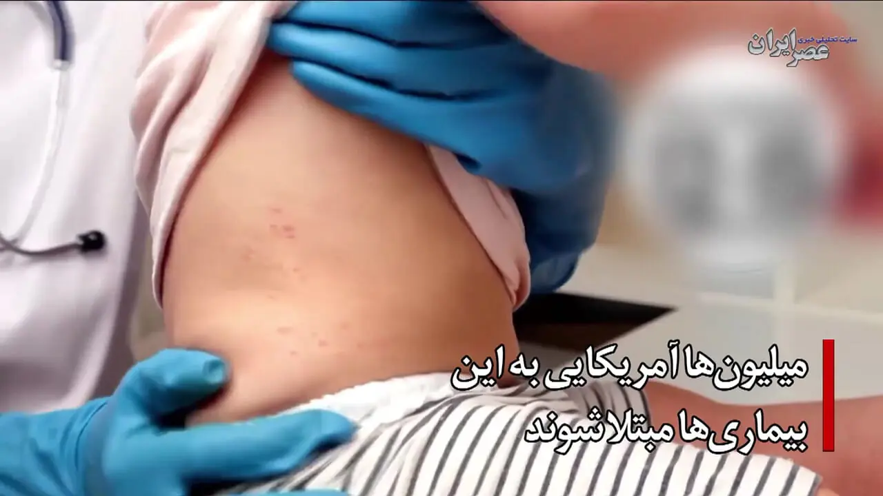 ببینید؛ ریشه‌کنی سرخک در ایران در معرض خطر؛ افزایش موارد ابتلا در جهان