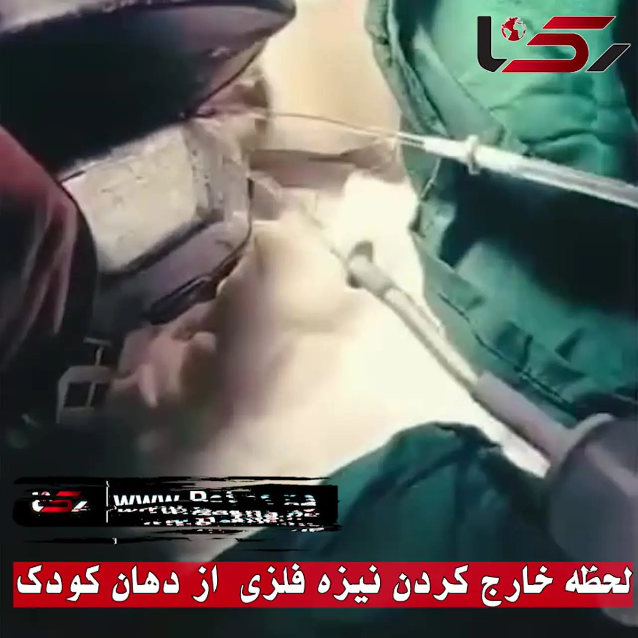 ببینید؛ خارج کردن نیزه فلزی از دهان کودک ۱۱ ساله در ایرانشهر