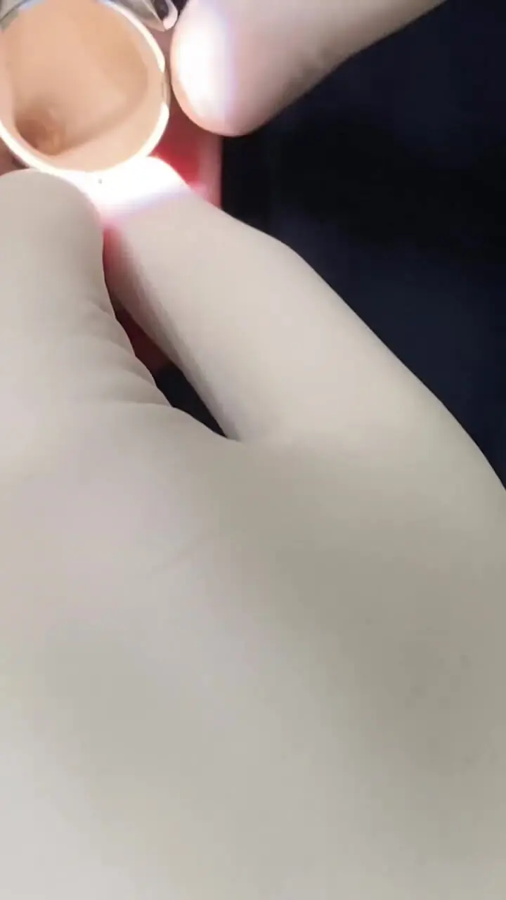 ببینید؛ لحظه خارج کردن عنکبوت زنده از گوش زن باردار بعد از ۵ روز در ایران