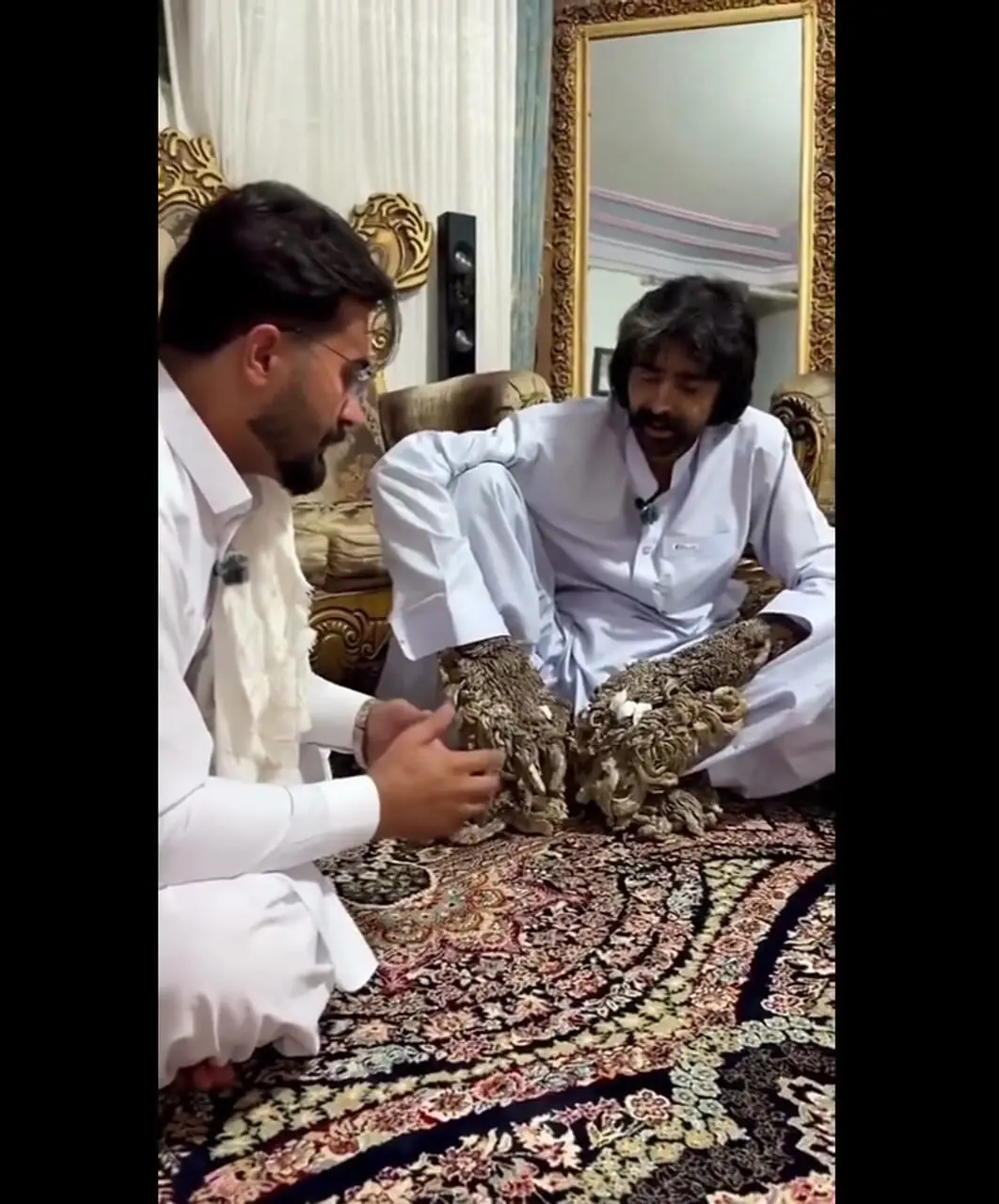 مرد درختی برای درمان راهی آمریکا شد